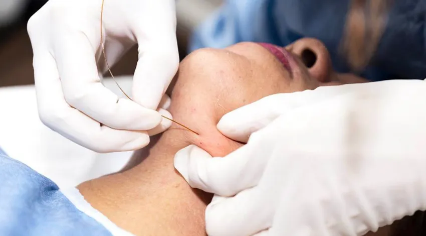 Vlarus exclusive importer of ENDOLIFT